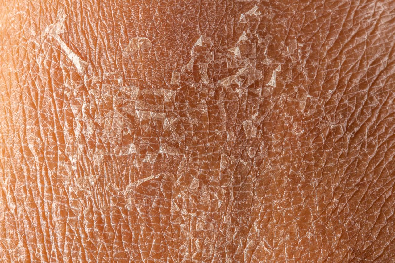 Dry Skin